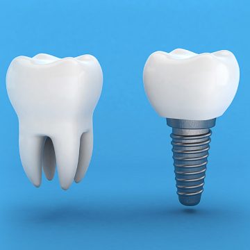 What Not to Do Before Your Dental Implant Surgery