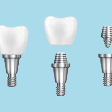 What Not to Do Before Your Dental Implant Surgery