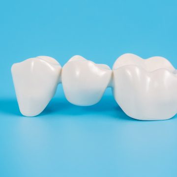 How to Brush and Floss Dental Bridges?