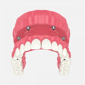 All-on-4 Vs. Traditional Implants: What’s the Difference?