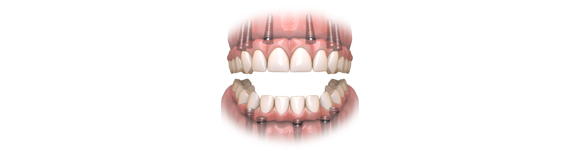 Hybridge Dental Implants