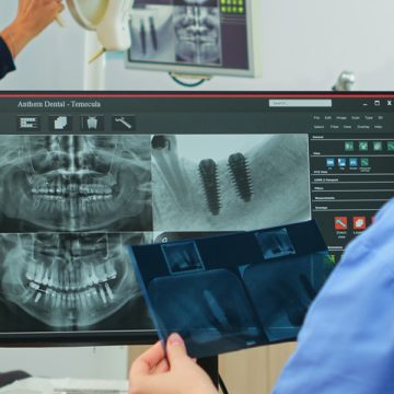 Healing After a Bone Graft: Tips for a Smooth Recovery