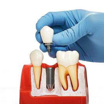 5 Life-Changing Benefits of Choosing Hybridge Dental Implants