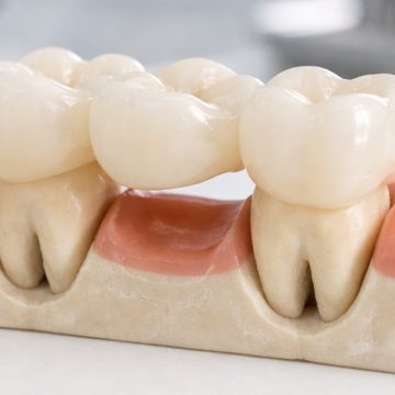 Can Dental Bridges Improve the Way You Eat and Speak?