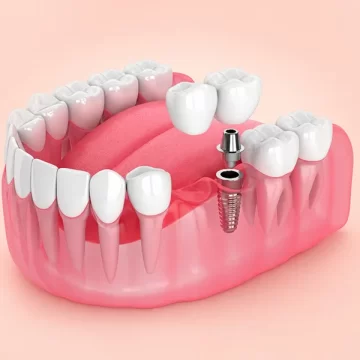 Can a Dental Bridge Restore Chewing and Speaking Ability?